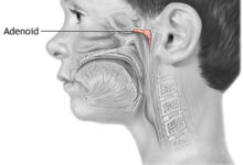 Adenoidid: Causes, Symptoms, Diagnosis, and Treatment