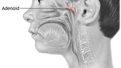 Adenoidid: Causes, Symptoms, Diagnosis, and Treatment