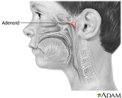 Adenoidid: Causes, Symptoms, Diagnosis, and Treatment